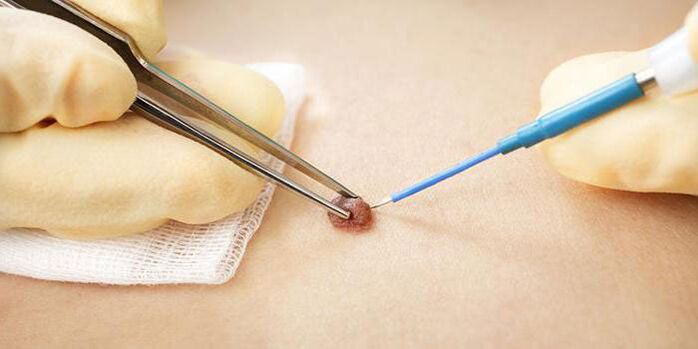 Electrocautery procedure to effectively remove papillomas