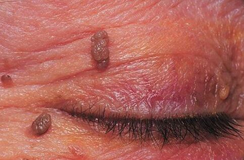 Papillomas on the skin of the eyelids require treatment