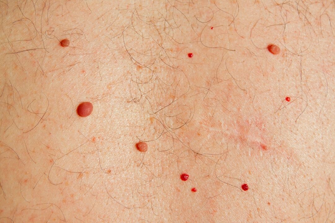 Papillomas on the body are caused by HPV