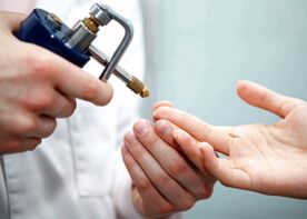 Remove warts on fingers with liquid nitrogen