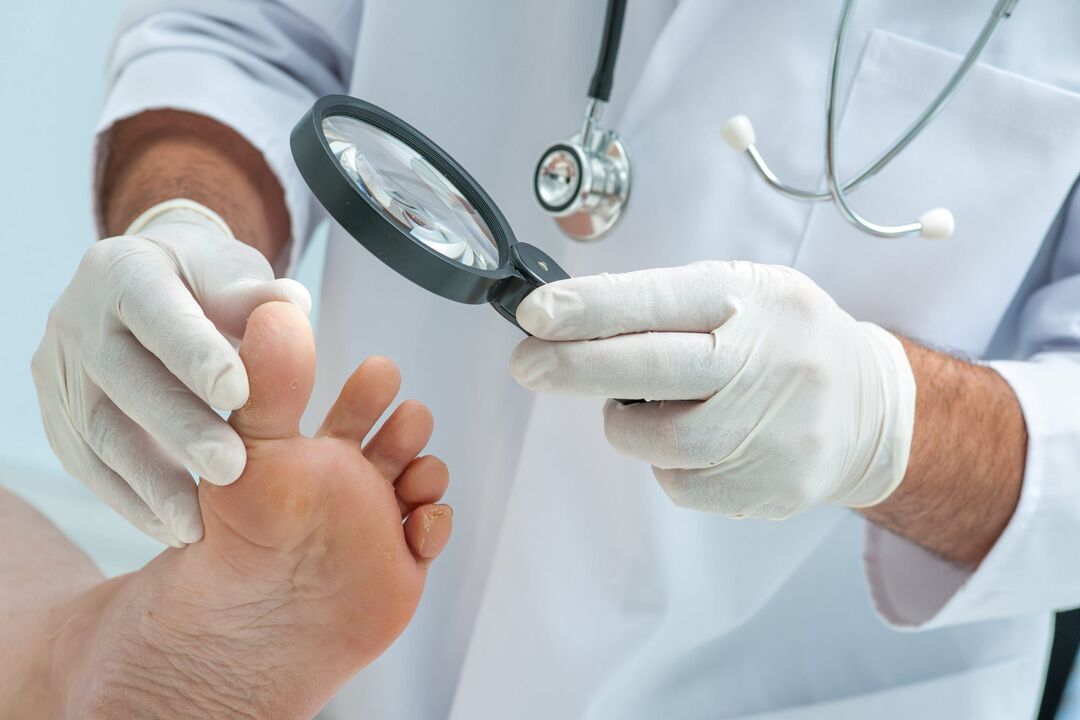 Doctor's wart treatment